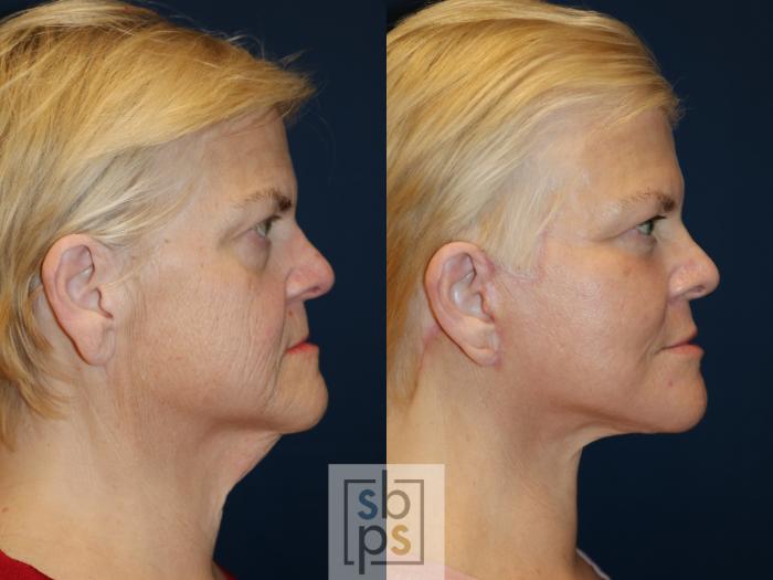 Before & After Facelift Case 682 Right Side View in Torrance, CA