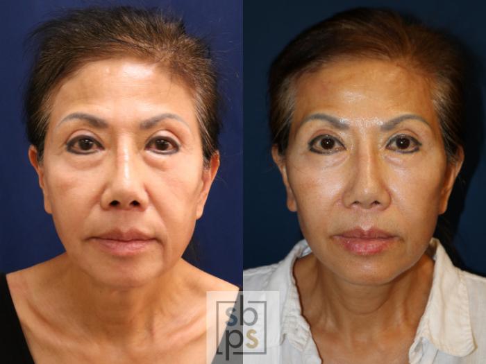 Before & After Facelift Case 726 Front View in Los Angeles & Torrance, CA, CA