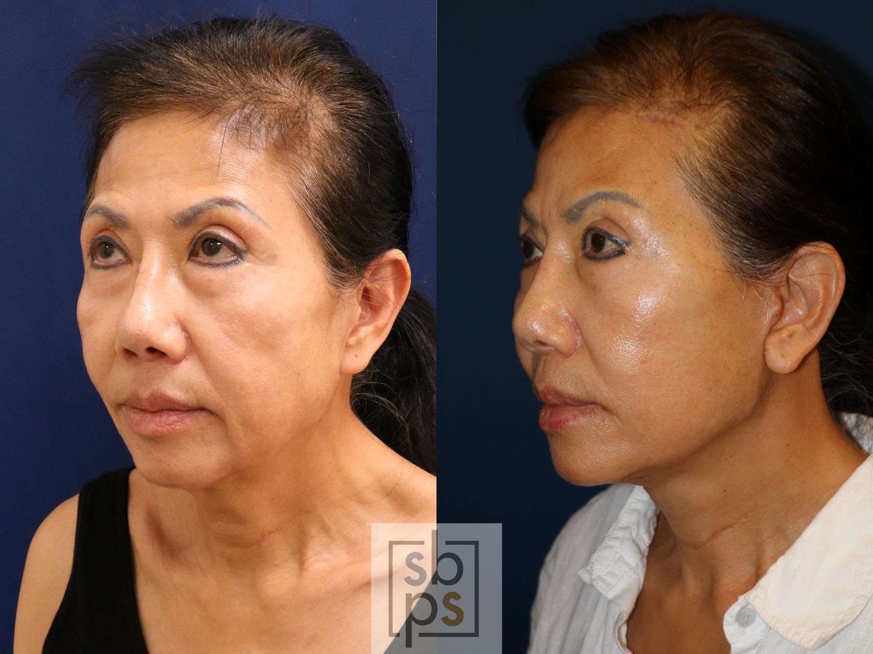 Before & After Facelift Case 726 Left Oblique View in Torrance & Los Angeles, CA, CA