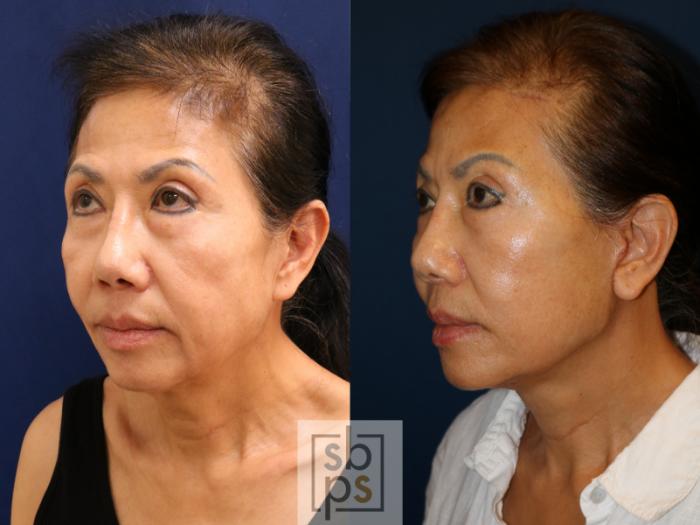 Before & After Facelift Case 726 Left Oblique View in Los Angeles & Torrance, CA, CA