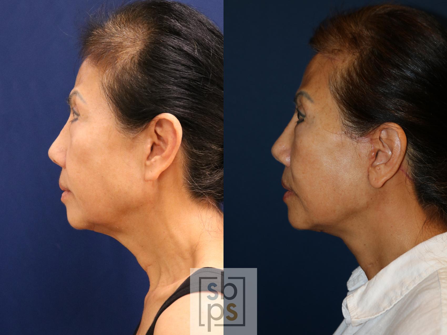 Before & After Facelift Case 726 Left Side View in Torrance & Los Angeles, CA, CA