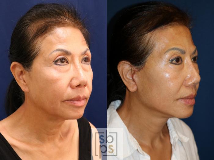 Before & After Facelift Case 726 Right Oblique View in Los Angeles & Torrance, CA, CA