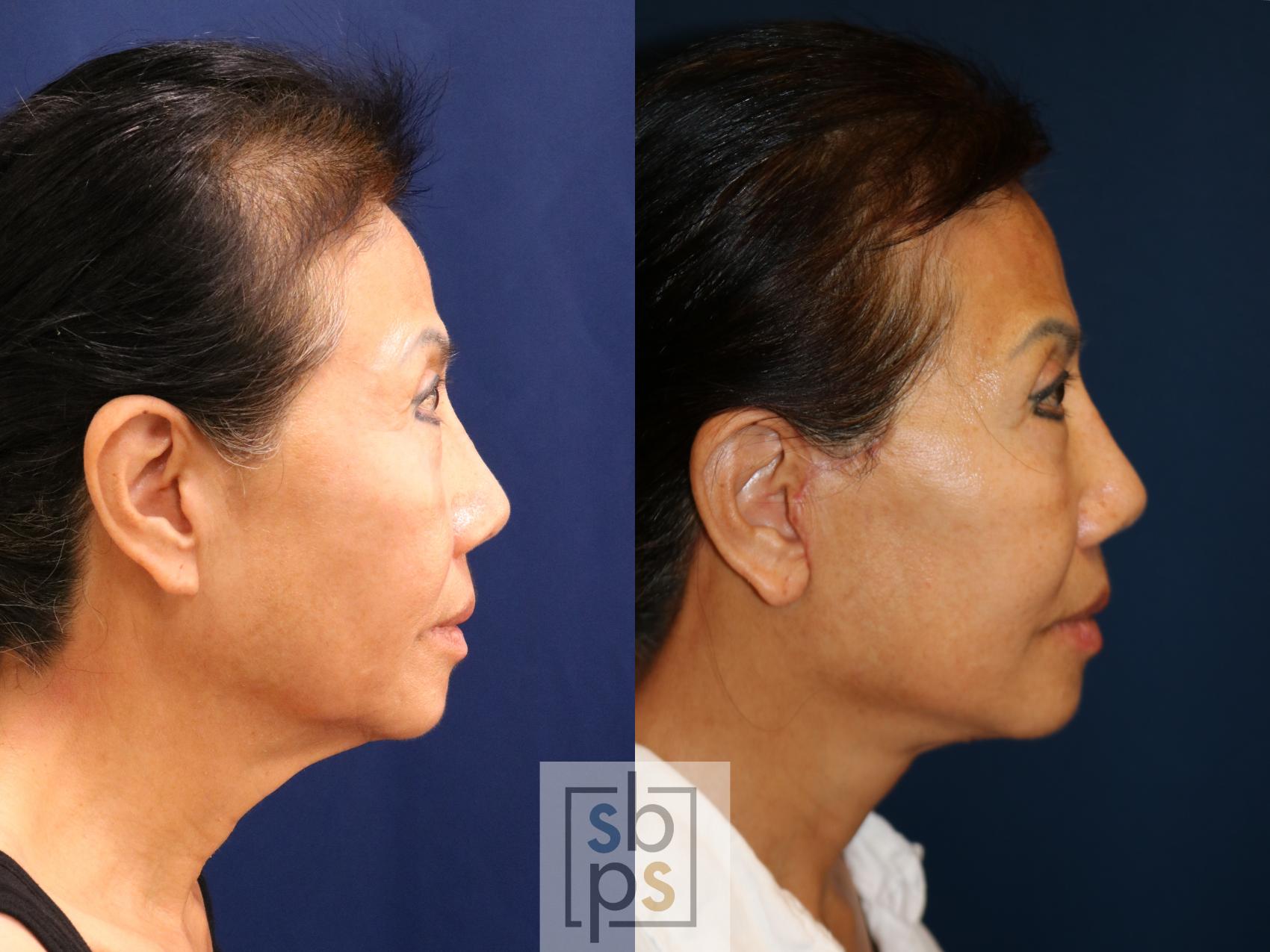 Before & After Facelift Case 726 Right Side View in Torrance & Los Angeles, CA, CA