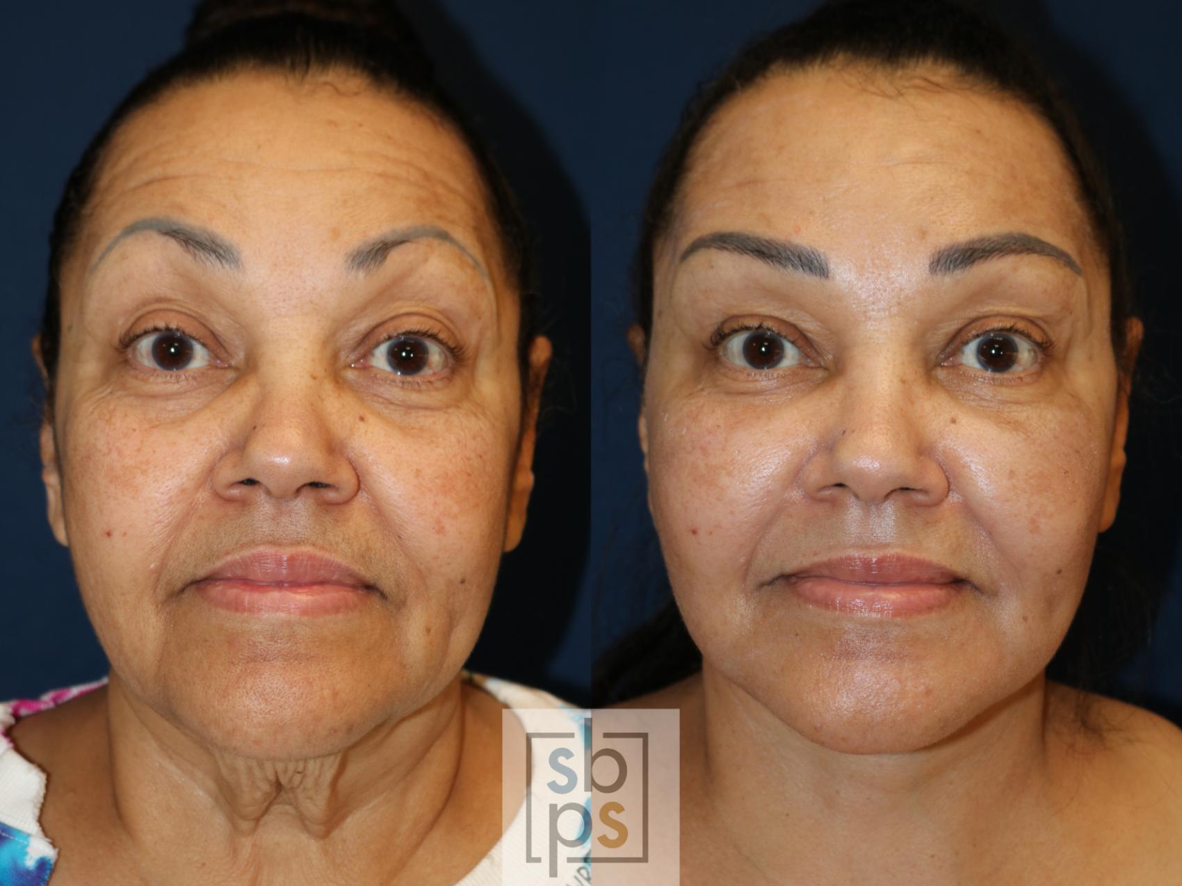 Before & After Facelift Case 738 Front View in Los Angeles, Torrance & Long Beach, CA