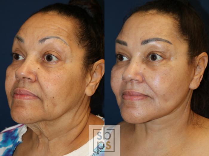 Before & After Facelift Case 738 Left Oblique View in Los Angeles, Torrance & Long Beach, CA