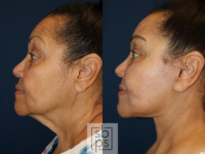 Before & After Facelift Case 738 Left Side View in Los Angeles, Torrance & Long Beach, CA