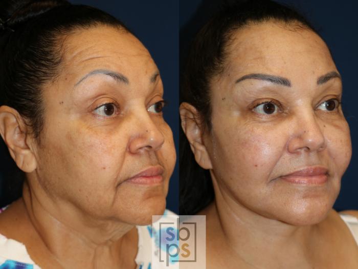 Before & After Facelift Case 738 Right Oblique View in Los Angeles, Torrance & Long Beach, CA