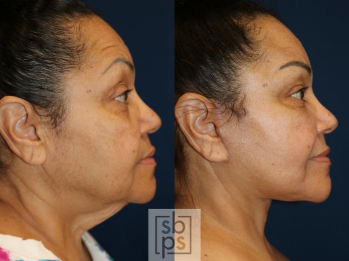Before & After Facelift Case 738 Right Side View in Los Angeles, Torrance & Long Beach, CA