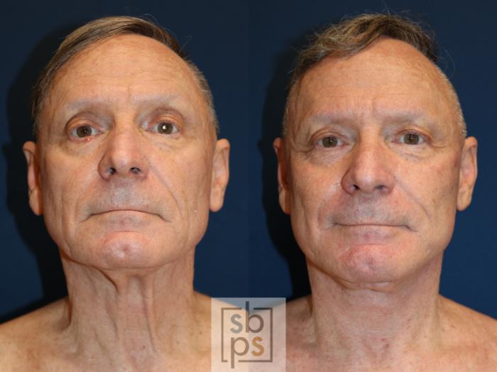 Before & After Facelift Case 739 Front View in Los Angeles, Torrance & Long Beach, CA