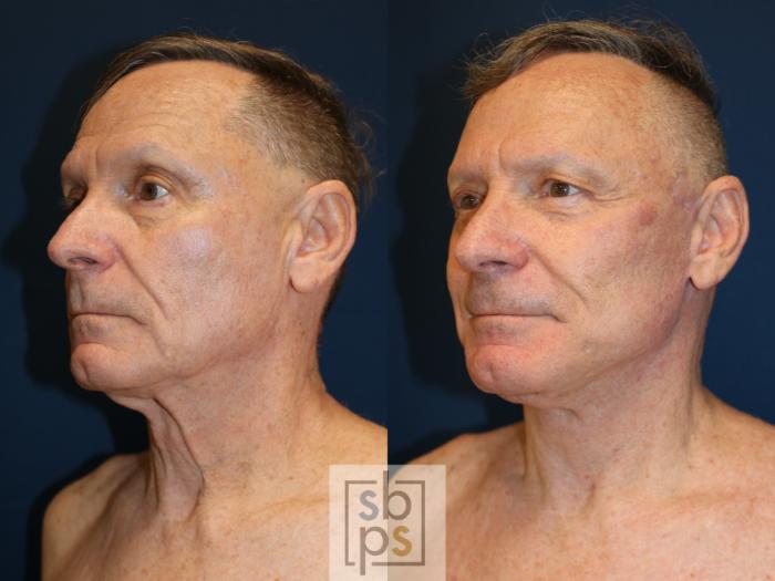 Before & After Facelift Case 739 Left Oblique View in Los Angeles, Torrance & Long Beach, CA