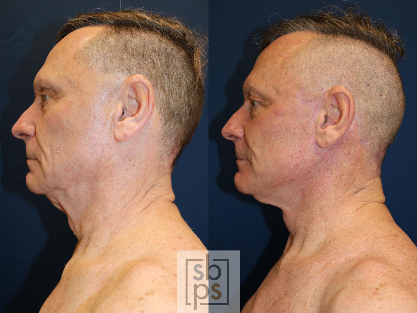 Before & After Facelift Case 739 Left Side View in Los Angeles, Torrance & Long Beach, CA