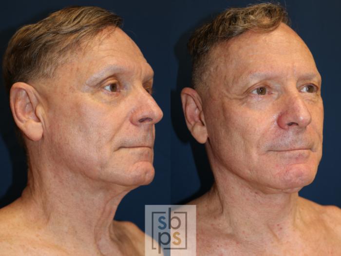 Before & After Facelift Case 739 Right Oblique View in Los Angeles, Torrance & Long Beach, CA