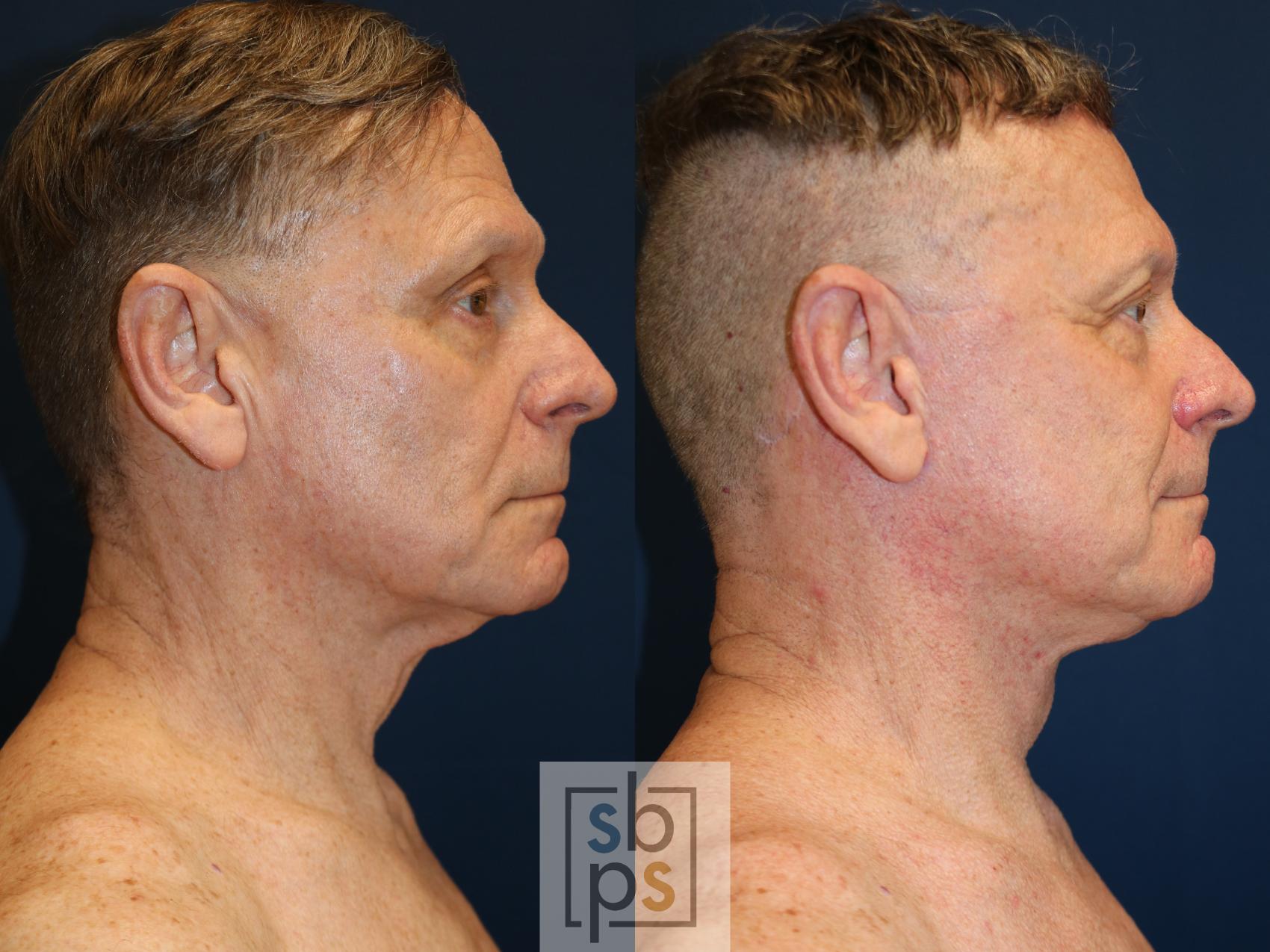 Before & After Facelift Case 739 Right Side View in Los Angeles, Torrance & Long Beach, CA