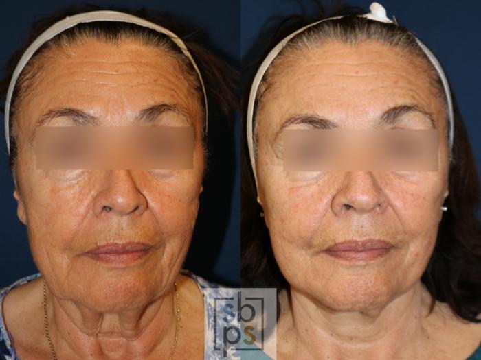Before & After Facelift Case 740 Front View in Los Angeles, Torrance & Long Beach, CA