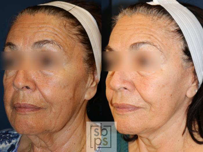 Before & After Facelift Case 740 Left Oblique View in Los Angeles, Torrance & Long Beach, CA