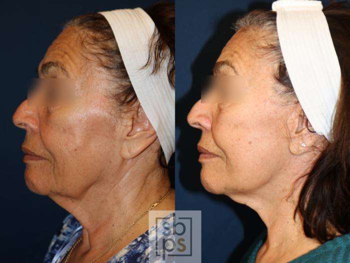 Before & After Facelift Case 740 Left Side View in Los Angeles, Torrance & Long Beach, CA