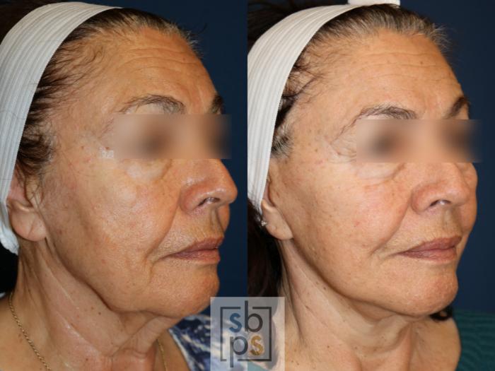Before & After Facelift Case 740 Right Oblique View in Los Angeles, Torrance & Long Beach, CA
