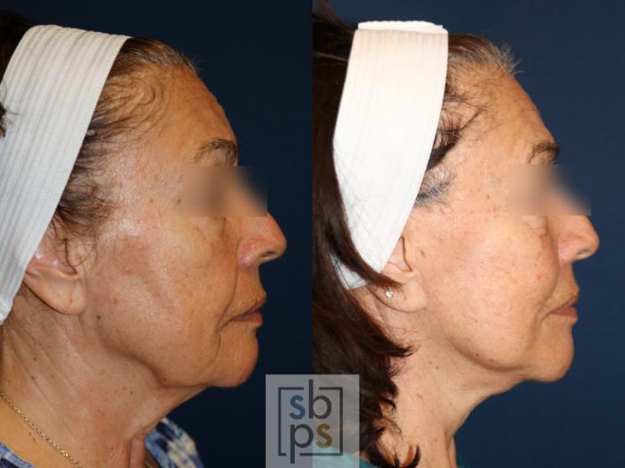 Before & After Facelift Case 740 Right Side View in Los Angeles, Torrance & Long Beach, CA