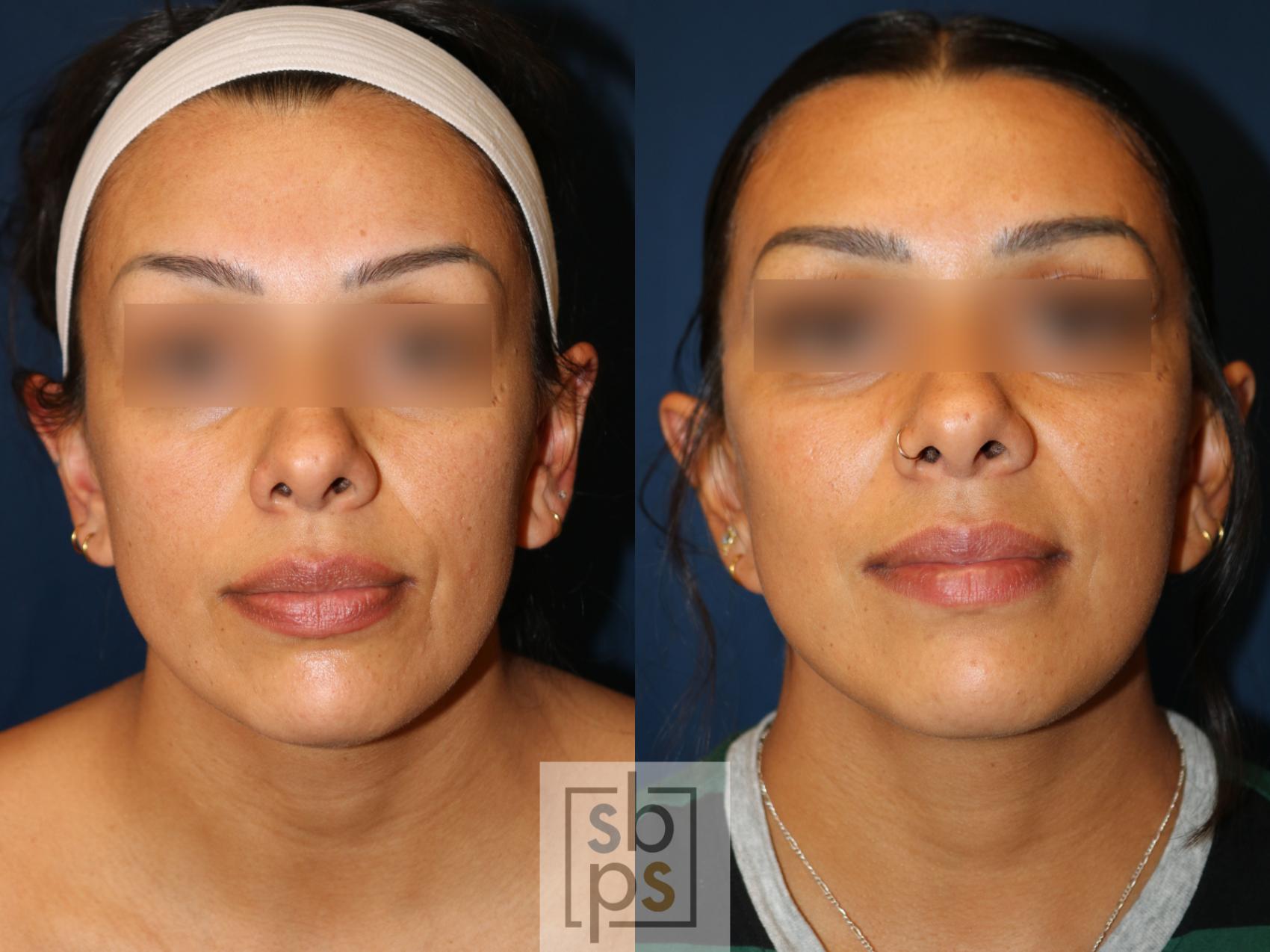 Before & After Facelift Case 741 Front View in Los Angeles, Torrance & Long Beach, CA