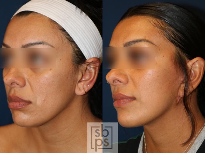 Before & After Facelift Case 741 Left Oblique View in Los Angeles, Torrance & Long Beach, CA