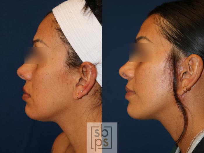 Before & After Facelift Case 741 Left Side View in Los Angeles, Torrance & Long Beach, CA
