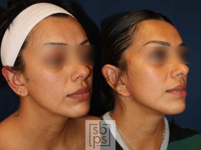 Before & After Facelift Case 741 Right Oblique View in Los Angeles, Torrance & Long Beach, CA