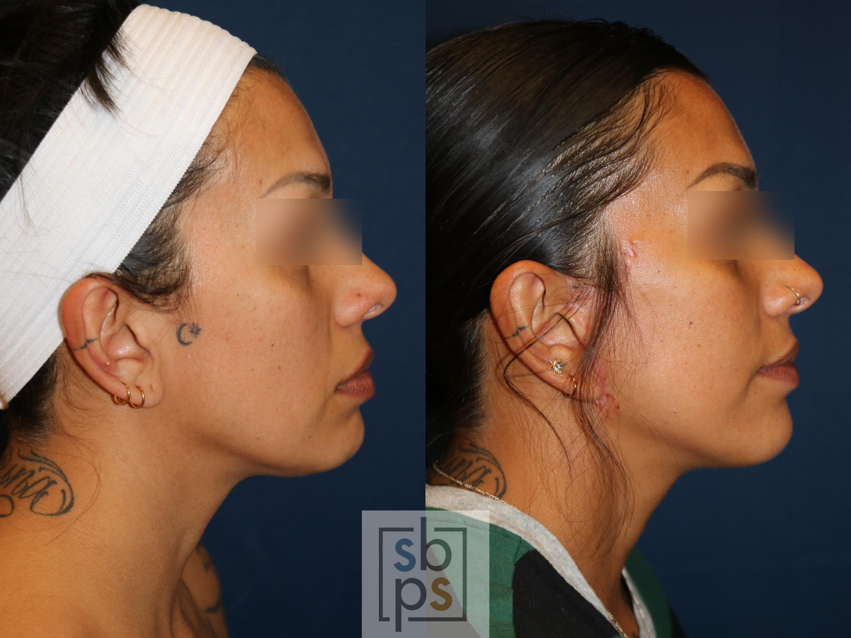 Before & After Facelift Case 741 Right Side View in Los Angeles, Torrance & Long Beach, CA