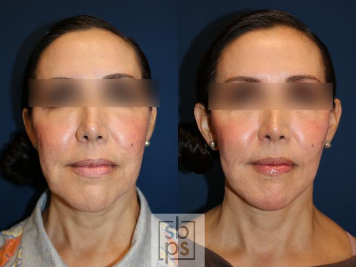 Before & After Facelift Case 742 Front View in Los Angeles, Torrance & Long Beach, CA