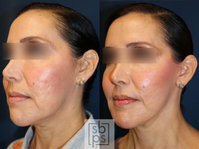 Before & After Facelift Case 742 Left Oblique View in Los Angeles, Torrance & Long Beach, CA
