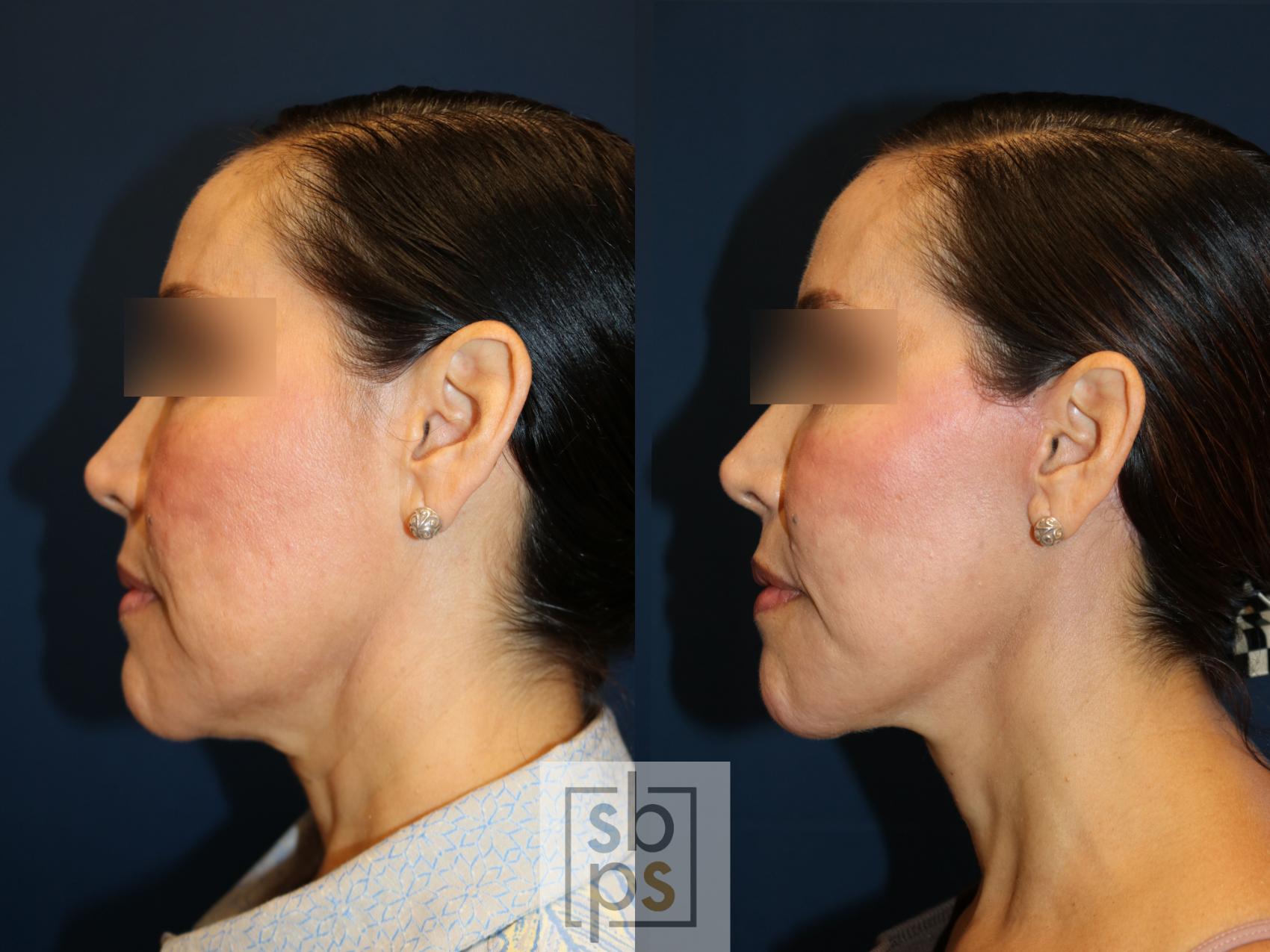 Before & After Facelift Case 742 Left Side View in Los Angeles, Torrance & Long Beach, CA