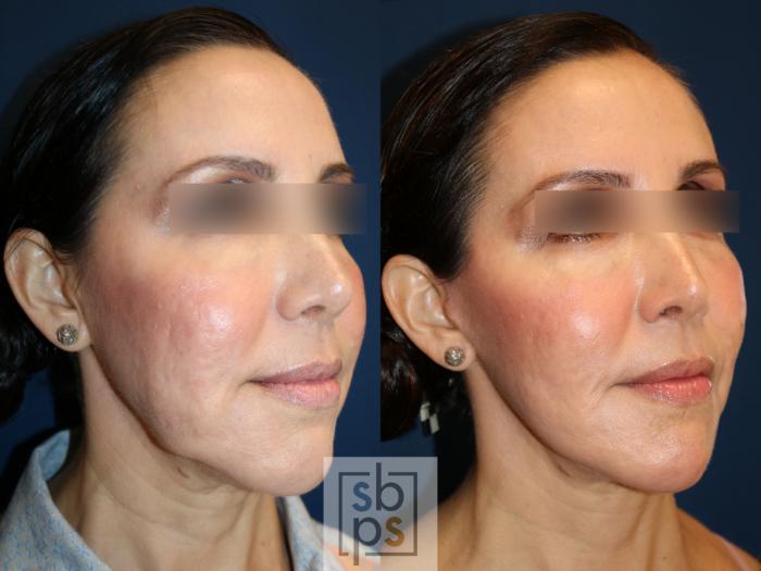 Before & After Facelift Case 742 Right Oblique View in Los Angeles, Torrance & Long Beach, CA