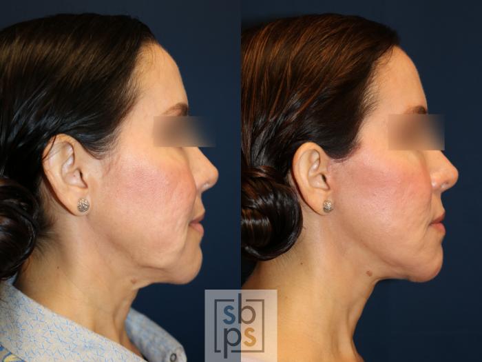 Before & After Facelift Case 742 Right Side View in Los Angeles, Torrance & Long Beach, CA