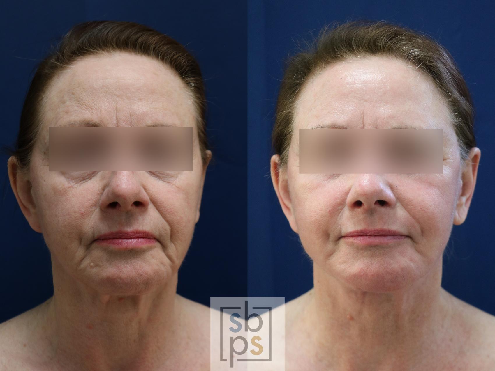 Before & After Facelift Case 743 Front View in Los Angeles, Torrance & Long Beach, CA