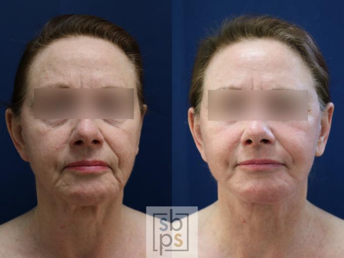 Before & After Facelift Case 743 Front View in Los Angeles, Torrance & Long Beach, CA