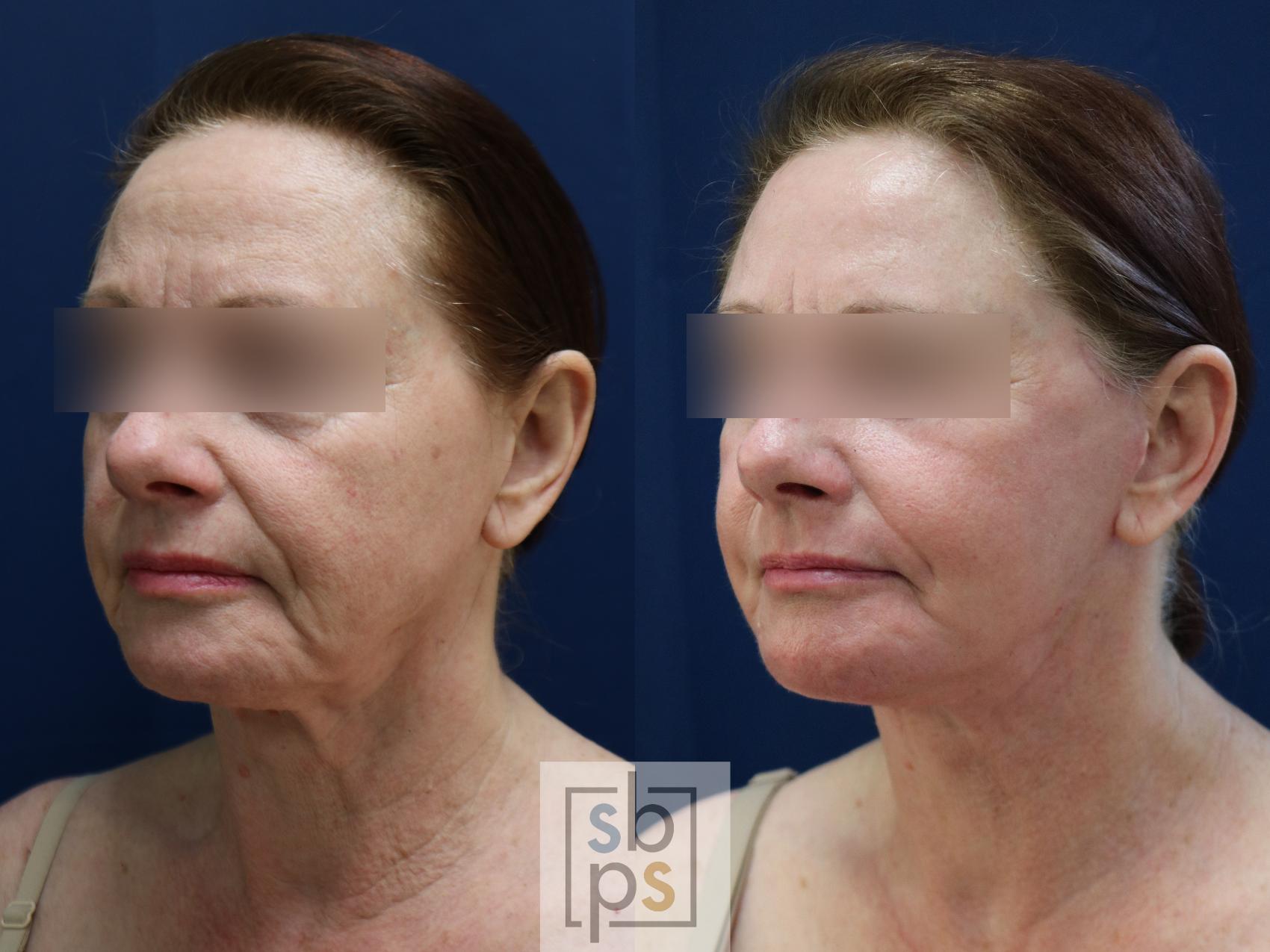 Before & After Facelift Case 743 Left Oblique View in Los Angeles, Torrance & Long Beach, CA