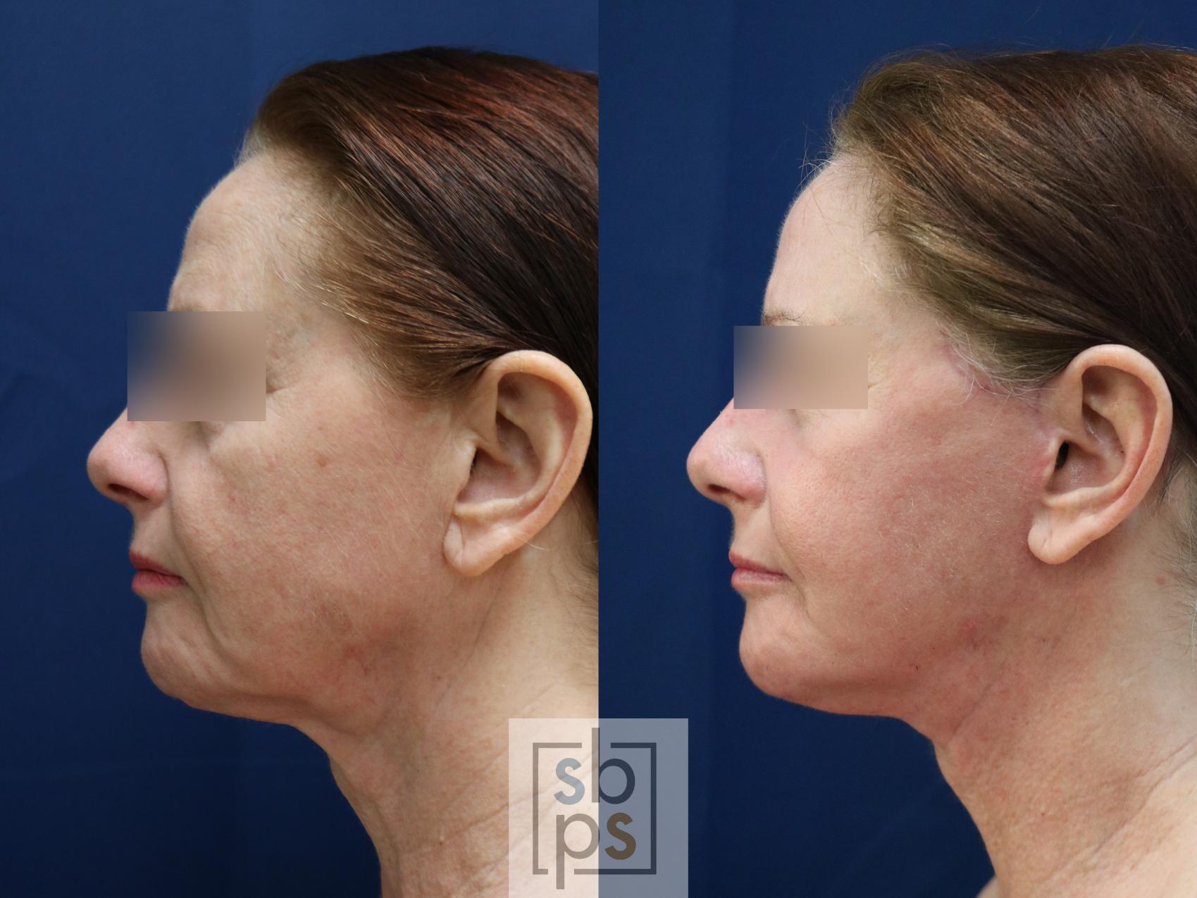 Before & After Facelift Case 743 Left Side View in Los Angeles, Torrance & Long Beach, CA