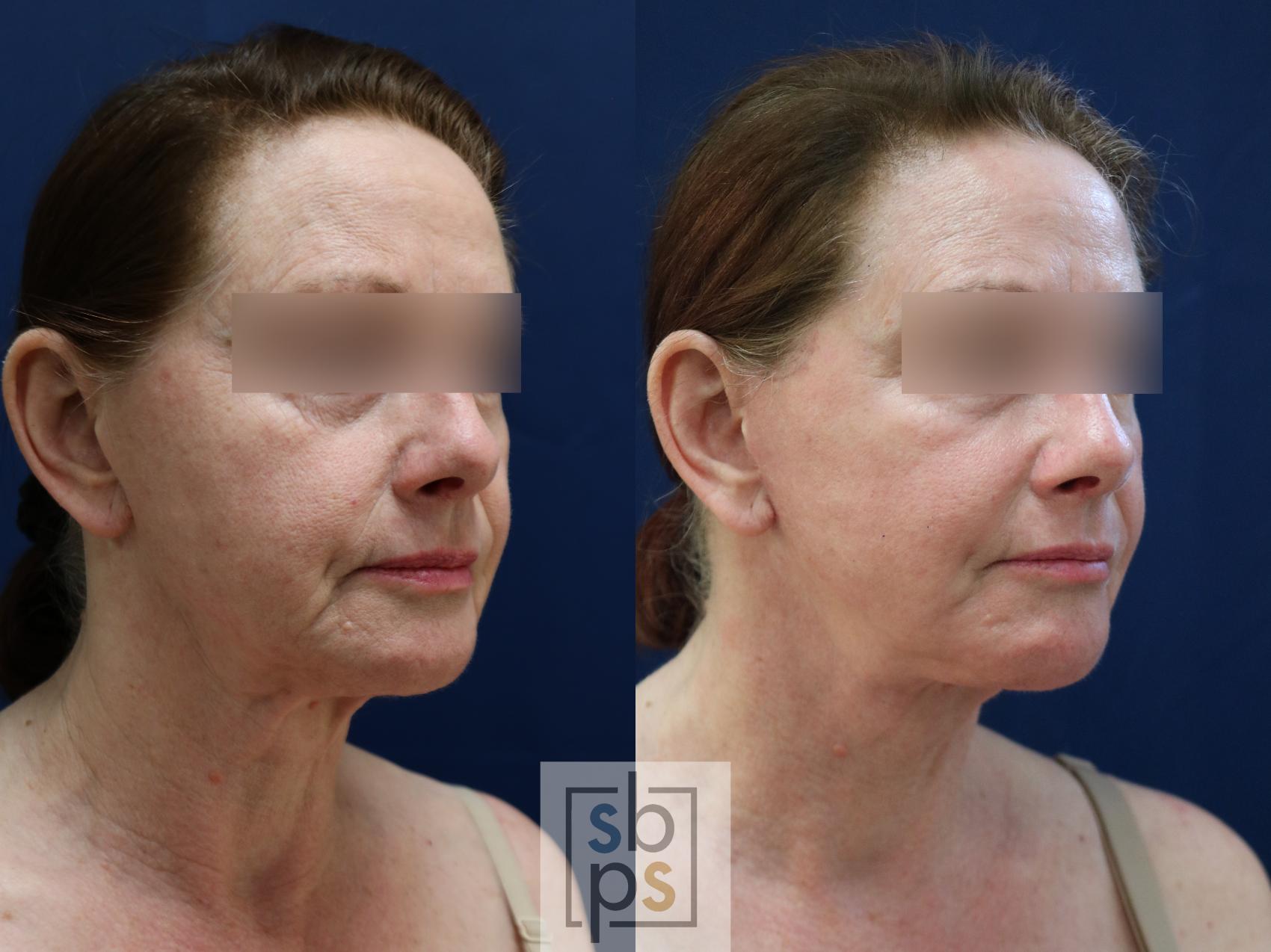 Before & After Facelift Case 743 Right Oblique View in Los Angeles, Torrance & Long Beach, CA
