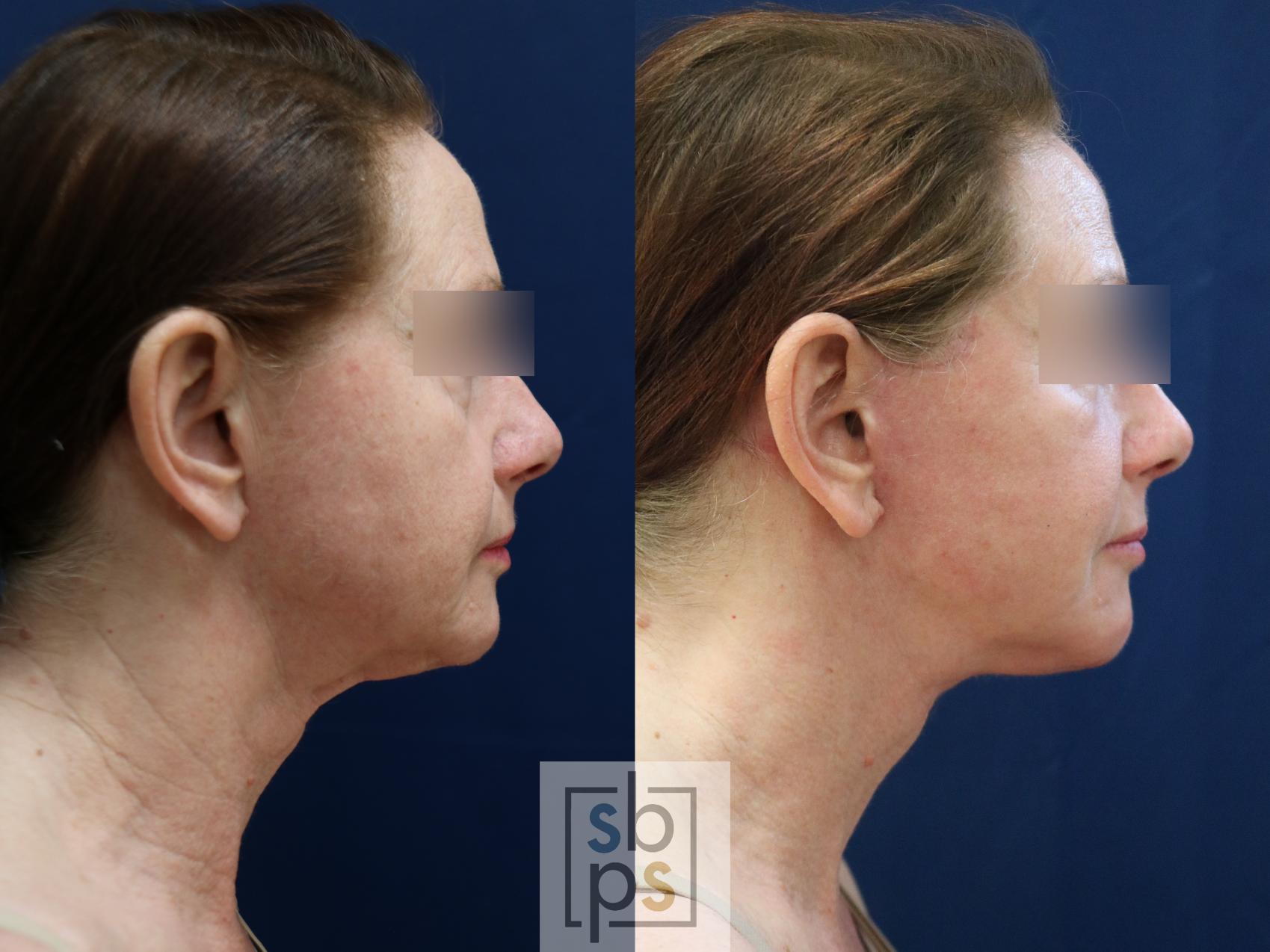 Before & After Facelift Case 743 Right Side View in Los Angeles, Torrance & Long Beach, CA
