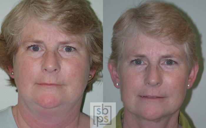 Before & After Brow Lift Case 16 View #1 View in Torrance, CA