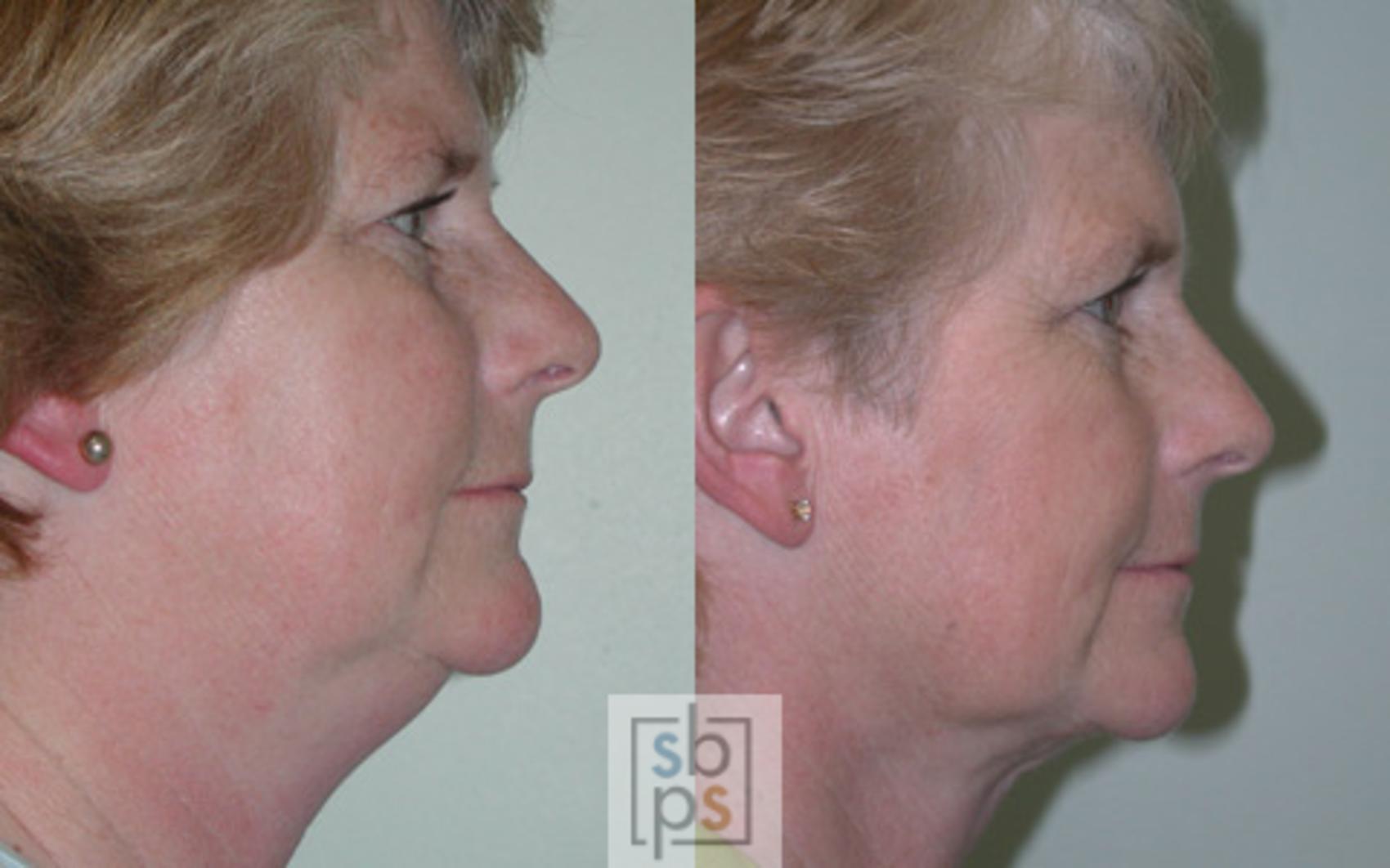Before & After Brow Lift Case 16 View #2 View in Torrance, CA