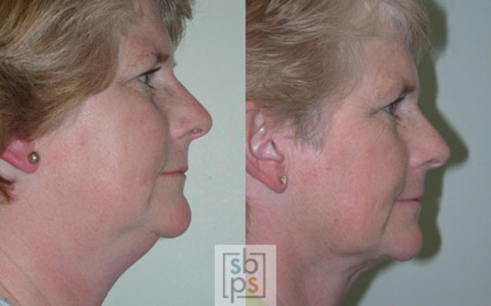 Before & After Facial Liposuction Case 16 View #2 View in Torrance, CA