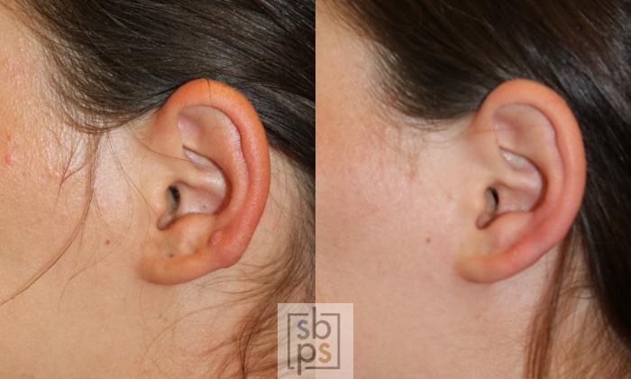 Before & After Facial Scar Revision Case 450 Left Side View in Torrance, CA