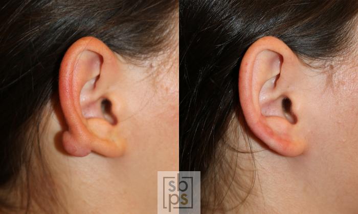 Before & After Facial Scar Revision Case 450 Right Side View in Torrance, CA