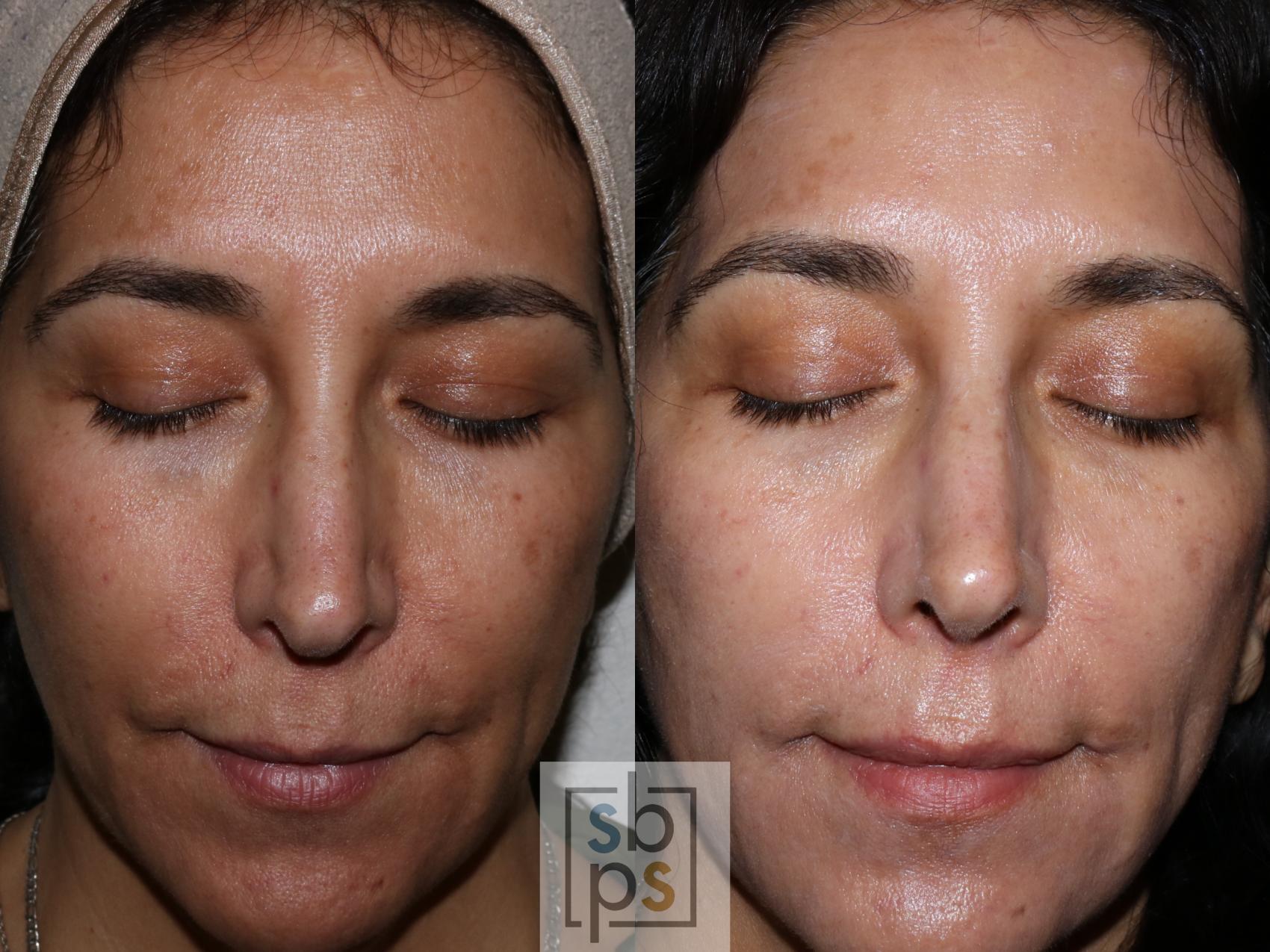 Before & After Facials Case 268 View #1 View in Torrance, CA