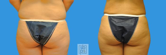 Before & After Liposuction Case 133 View #1 View in Torrance, CA