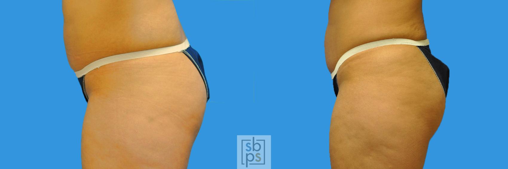 Before & After Buttock Augmentation Case 133 View #2 View in Torrance & Los Angeles, CA, CA