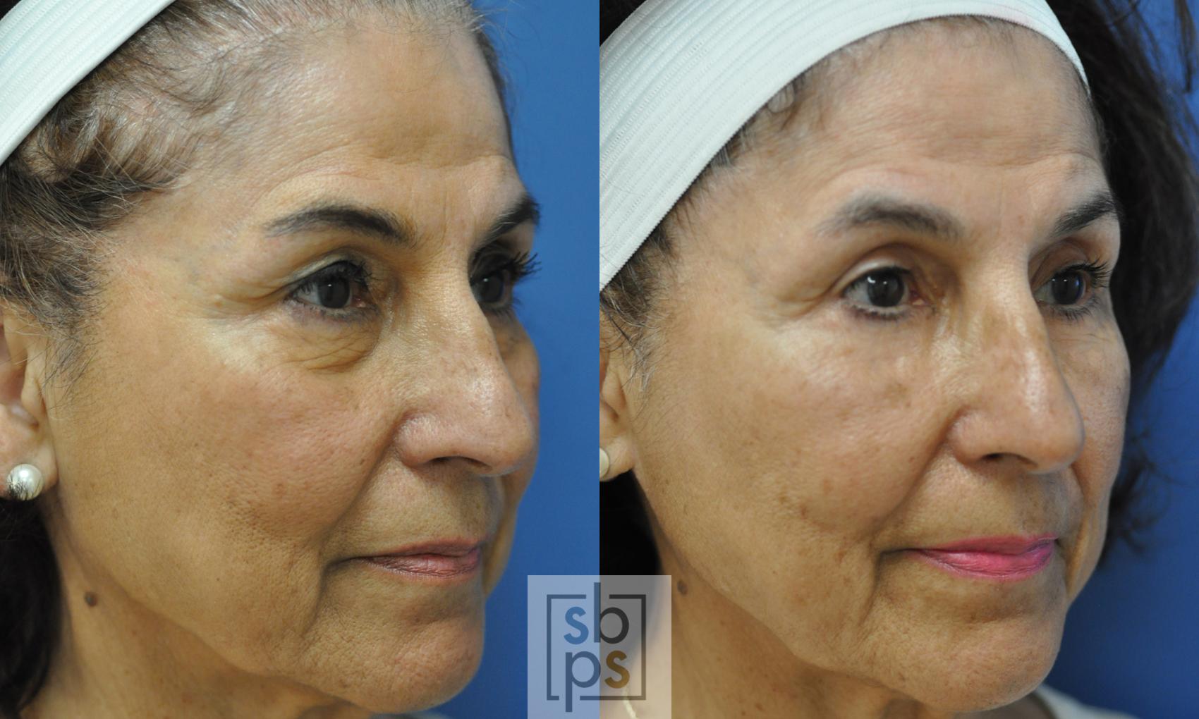 Before & After Eyelid Surgery (Blepharoplasty) Case 230 View #1 View in Torrance, CA