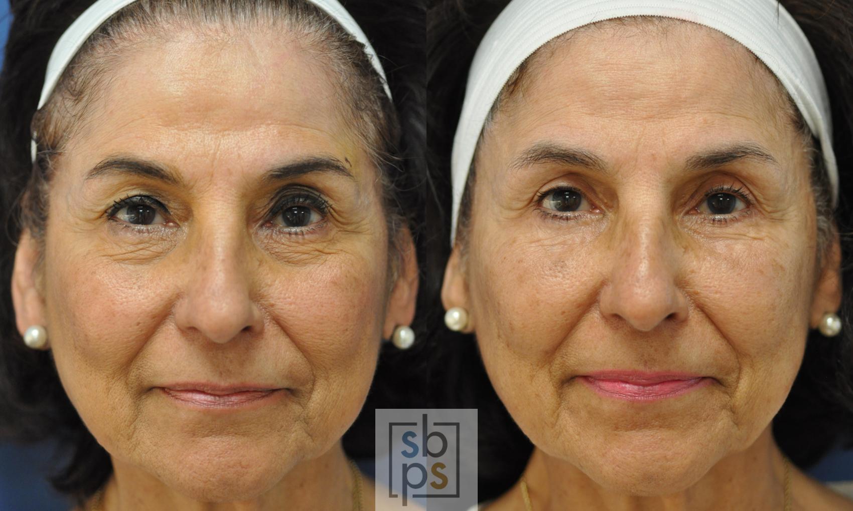 Before & After Eyelid Surgery (Blepharoplasty) Case 230 View #2 View in Torrance, CA
