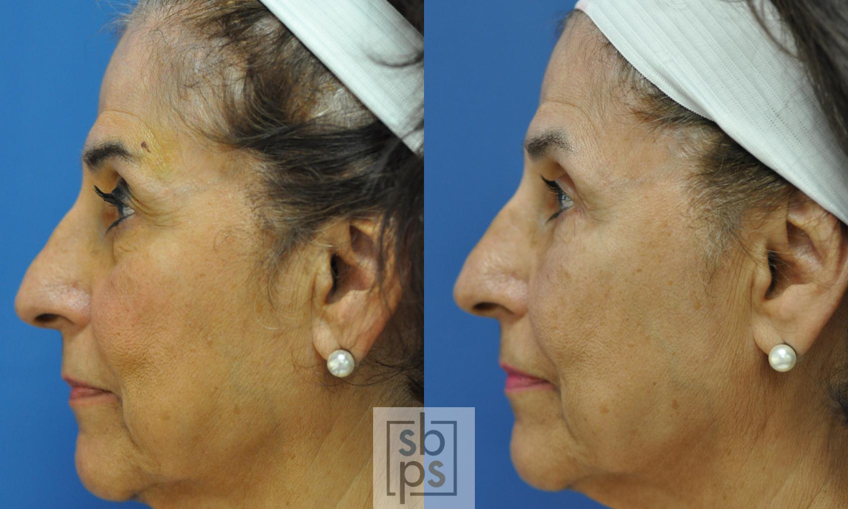 Before & After Eyelid Surgery (Blepharoplasty) Case 230 View #3 View in Torrance, CA