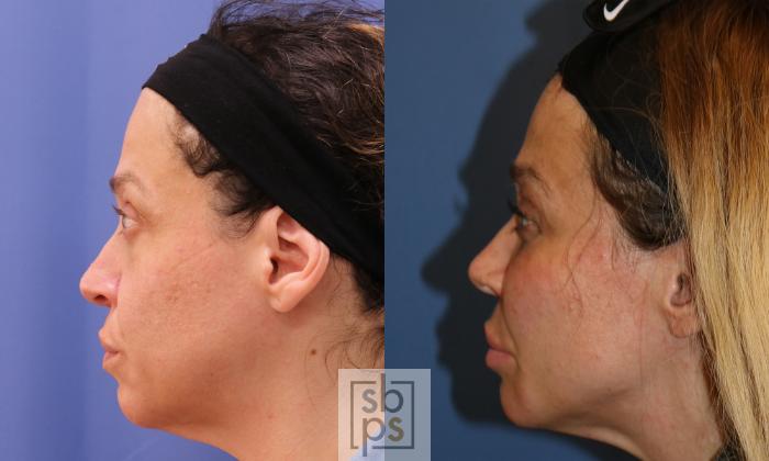 Before & After Fat Injection Case 476 Left Side View in Los Angeles & Torrance, CA, CA